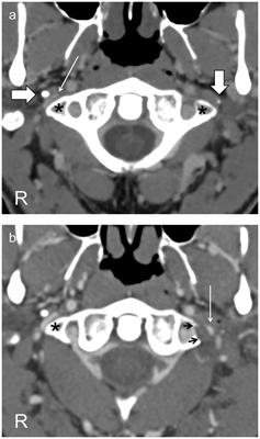 Case report: Post-traumatic Tourette syndrome resolving with treatment of jugular venous narrowing; reconciling organic brain dysfunction following whiplash trauma with the absence of direct brain injury